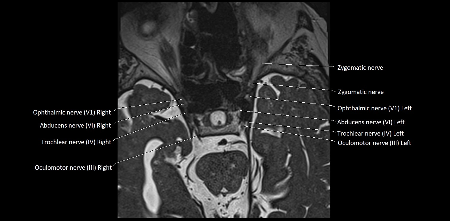 Cranial nerve anatomy axial MRI 3T image 26.webp